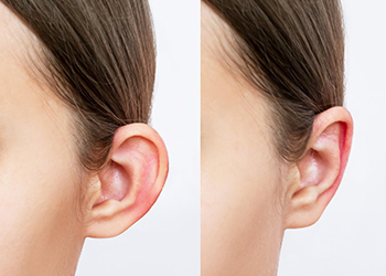 Otoplasty - Ear Reshaping Surgery Treatment | Cosmetic Ear Surgery