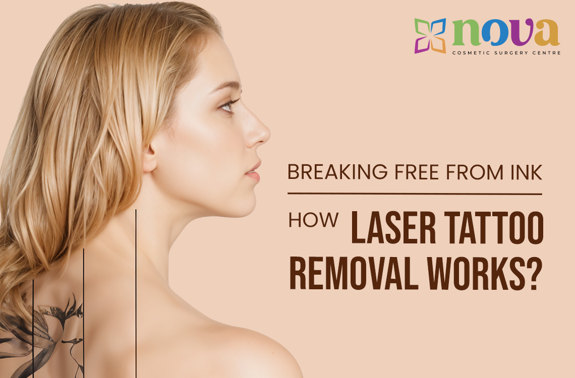 Breaking Free from Ink: How Laser Tattoo Removal Works