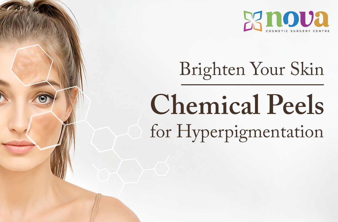 Brighten Your Skin: Chemical Peels for Hyperpigmentation