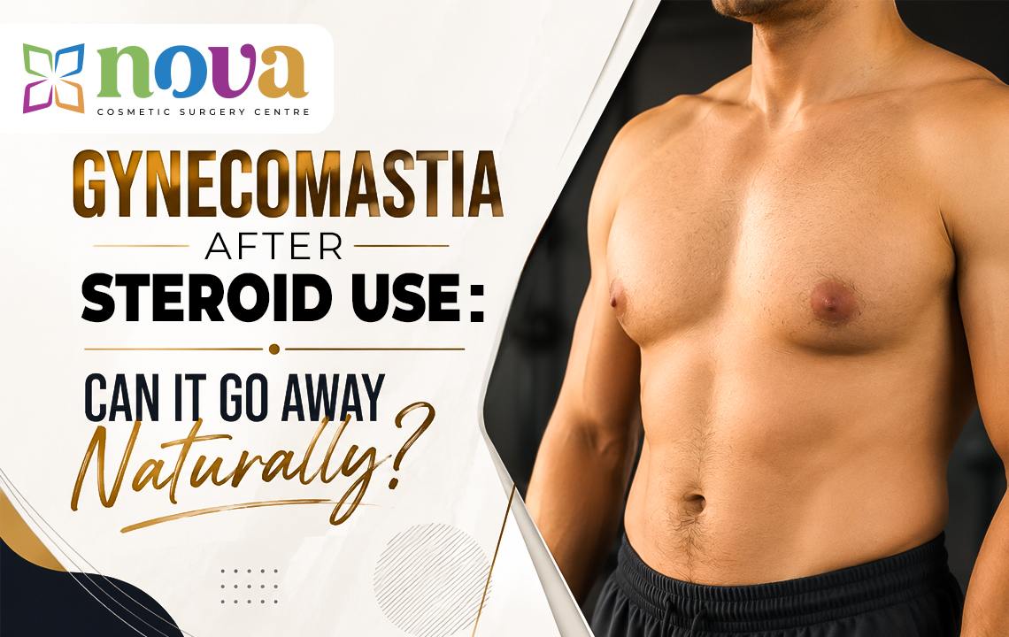 Gynecomastia After Steroid Use: Can It Go Away Naturally?