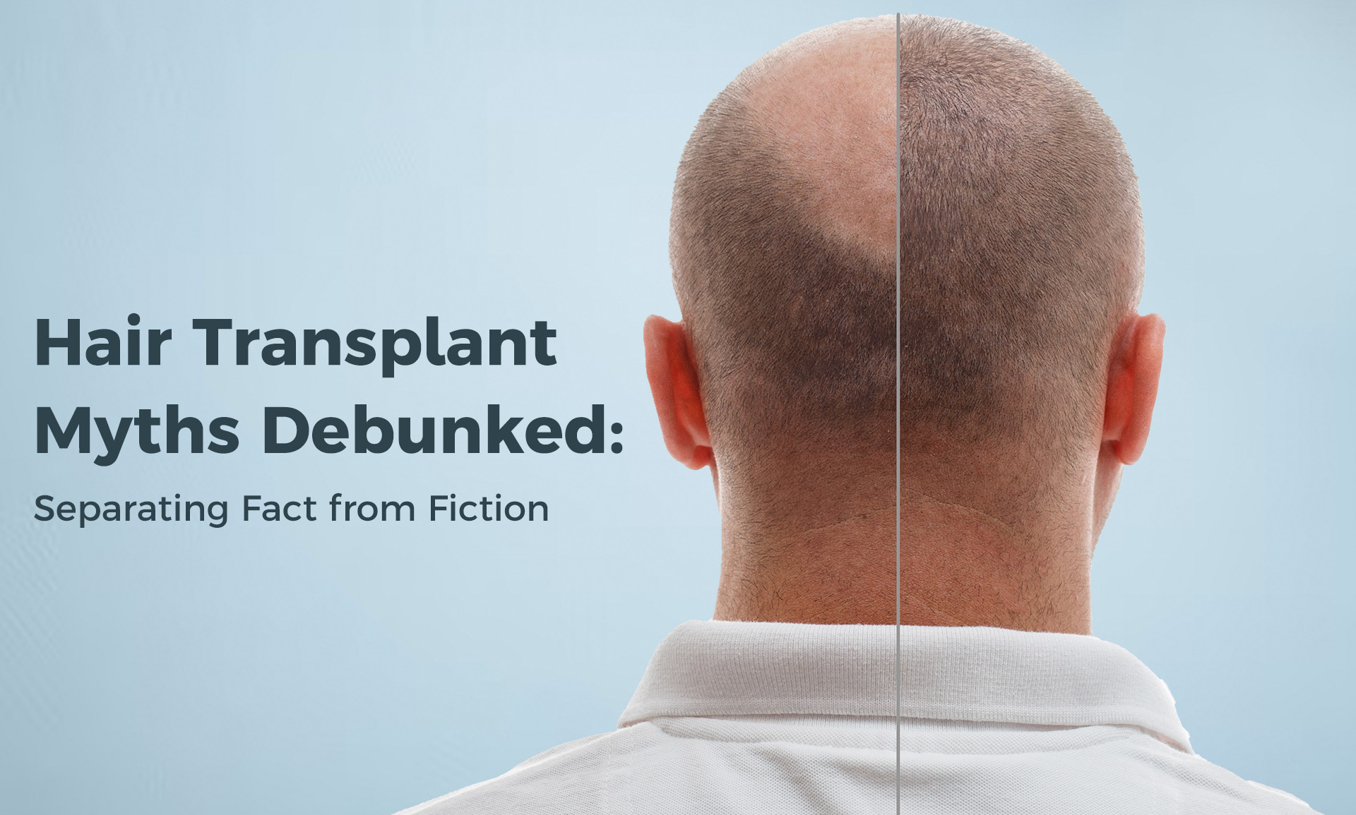 Hair Transplant Myths Debunked: Separating Fact from Fiction