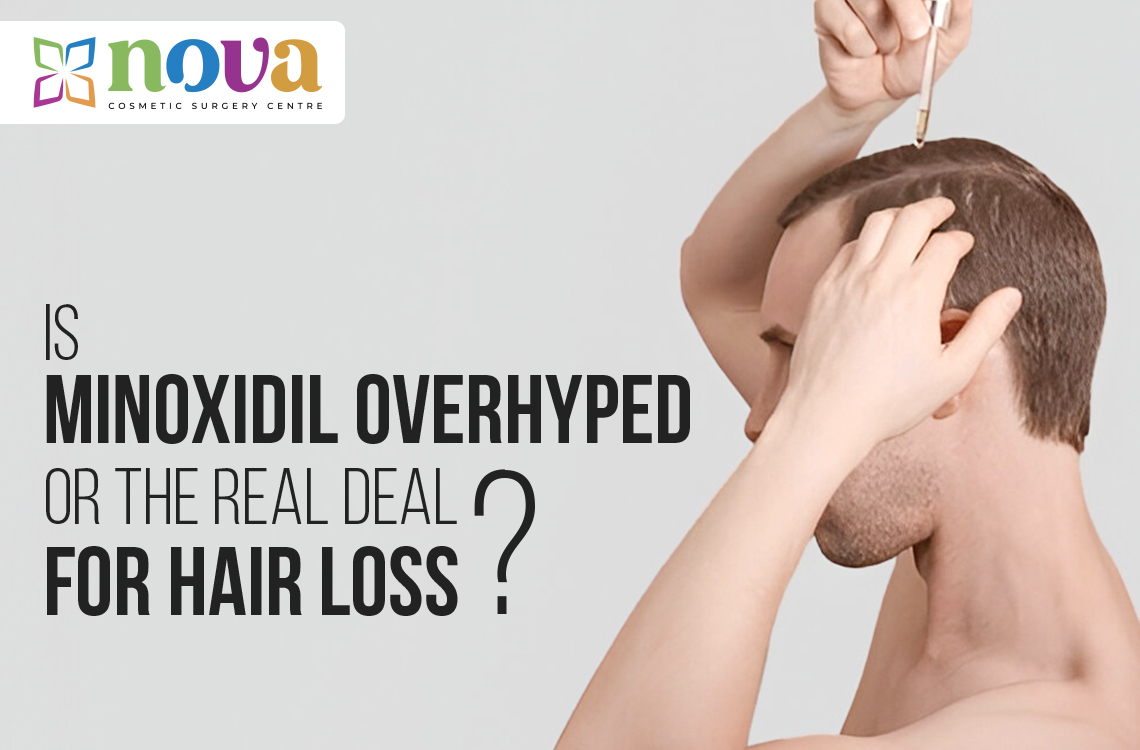 Is Minoxidil Overhyped or the Real Deal for Hair Loss?