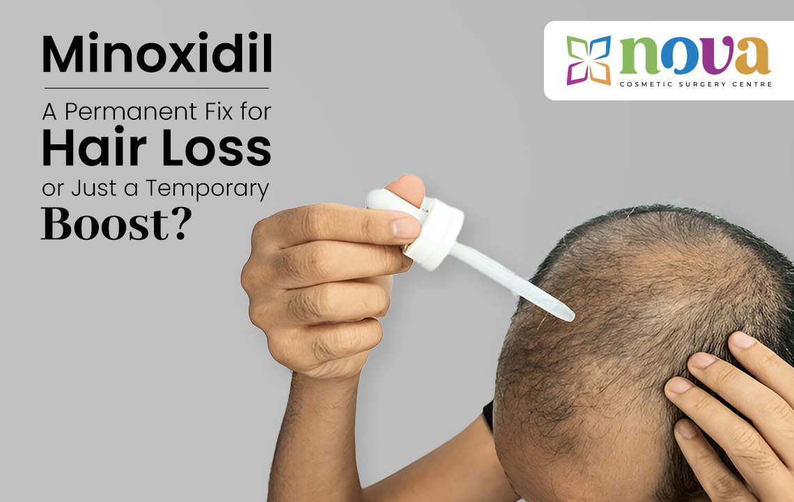 Minoxidil: A Permanent Fix for Hair Loss or Just a Temporary Boost?