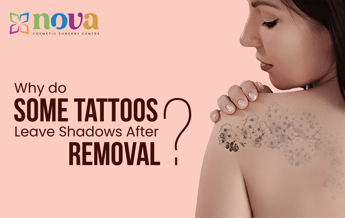 Why Do Some Tattoos Leave Shadows After Removal?